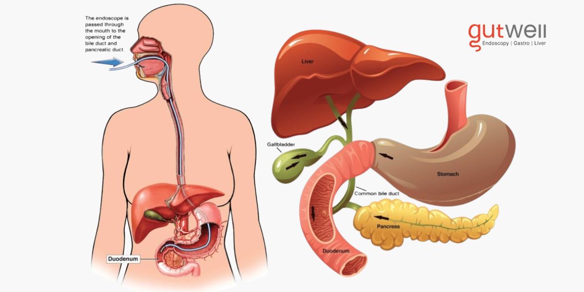ERCP in Gurgaon