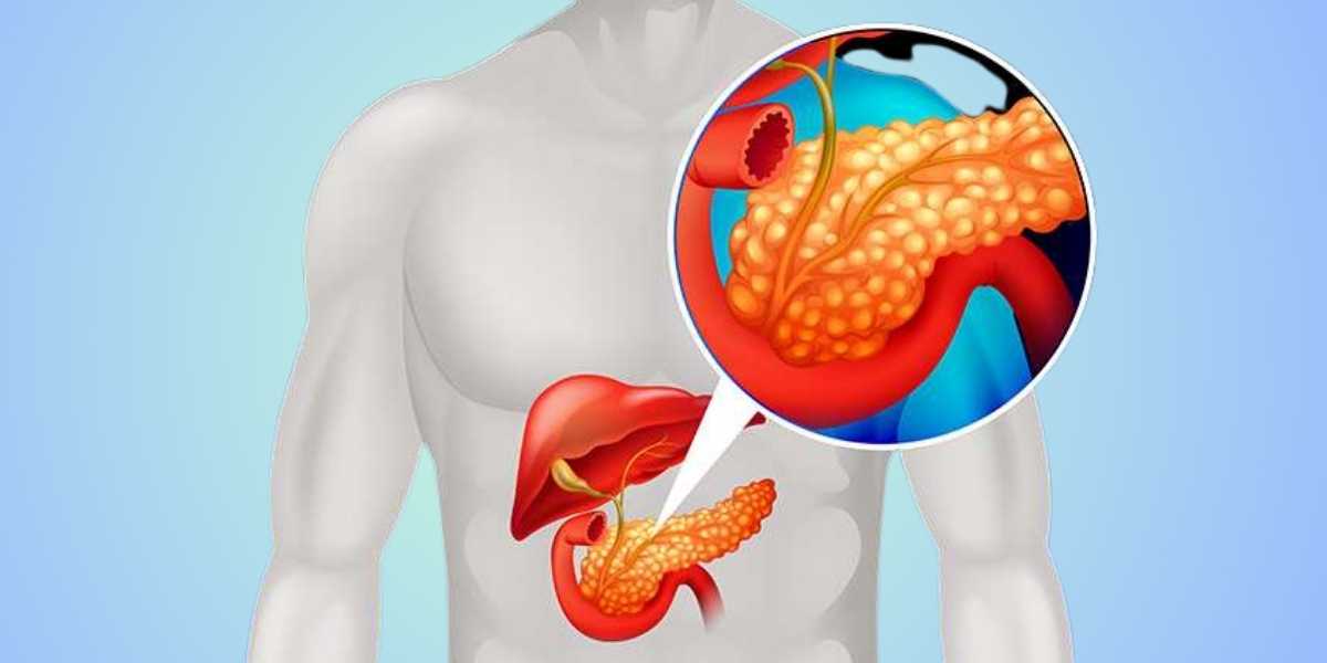 acute pancreatitis
