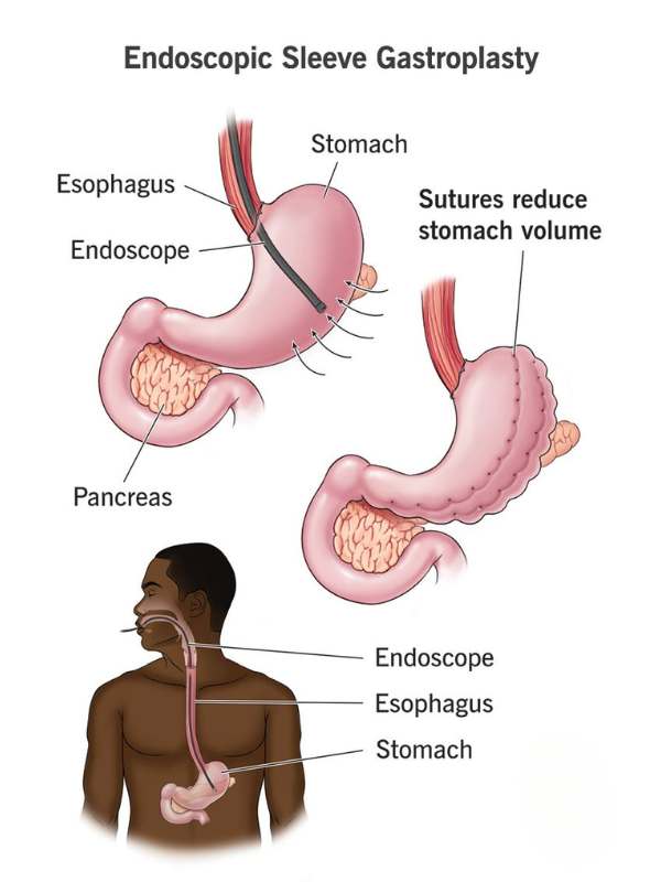 Endoscopic Sleeve Gastroplasty