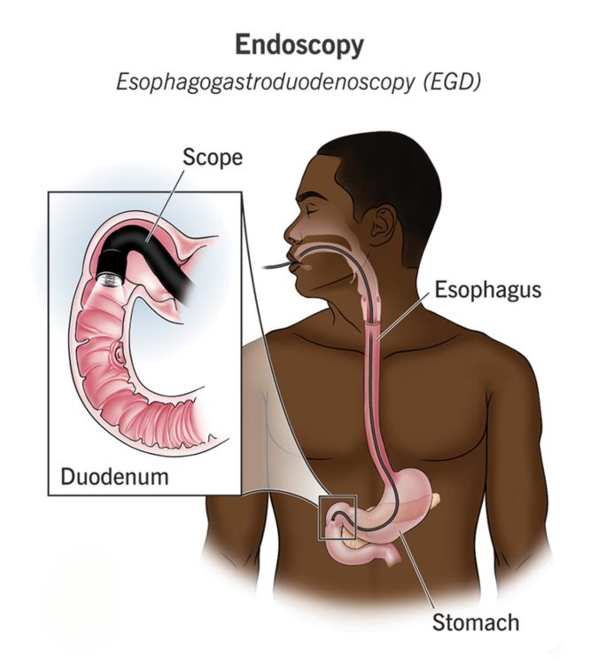 Endoscopy in Gurgaon