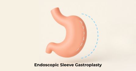 endoscopic Sleeve Gastroplasty in Gurgaon