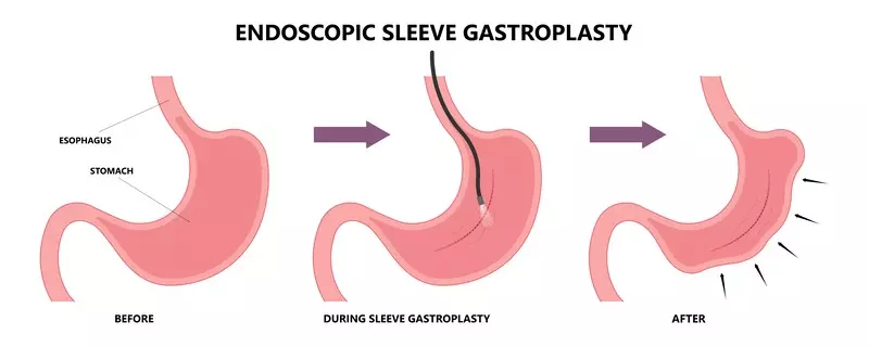 Endoscopic Sleeve Gastroplasty gurgaon