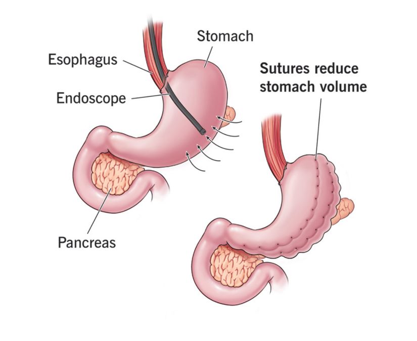 Endoscopic Sleeve Gastroplasty Gurgaon