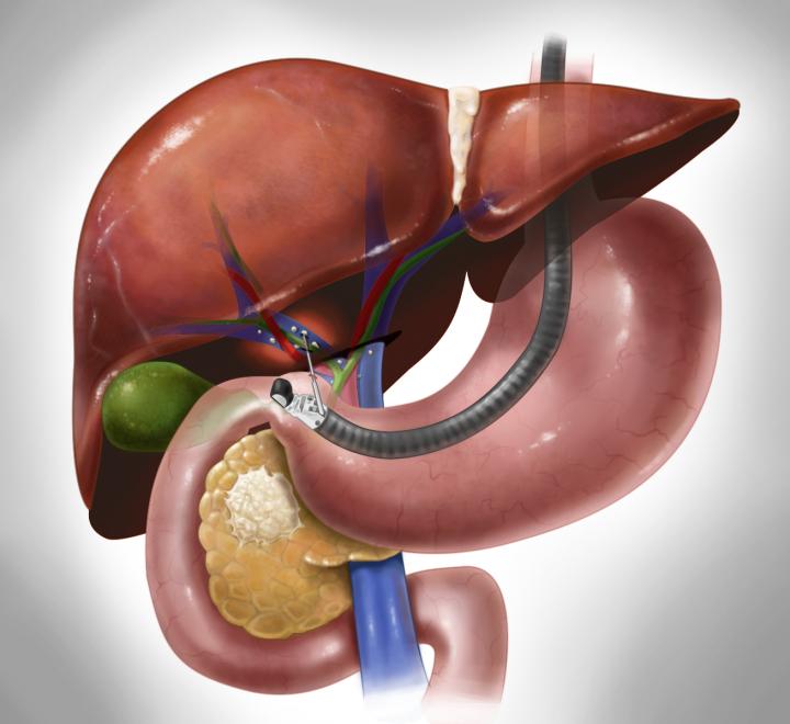 endoscopic Ultrasound in Gurgaon