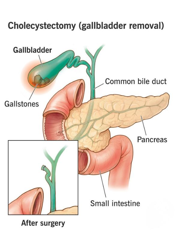 Gallbladder surgery in Gurgaon
