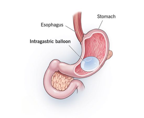 Intragastric Balloon Gurgaon