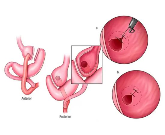 Transoral Outlet Reduction Gurgaon