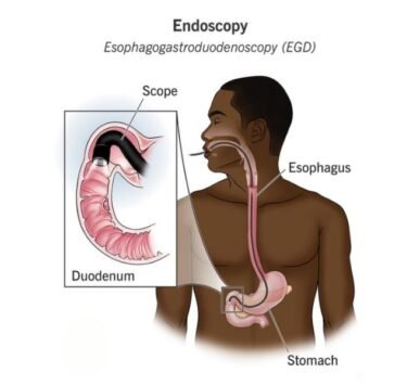 endoscopy in Gurgaon