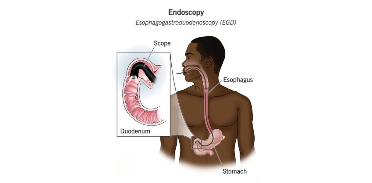 endoscopy in Gurgaon