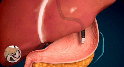 Advancement in Endoscopic Ultrasound