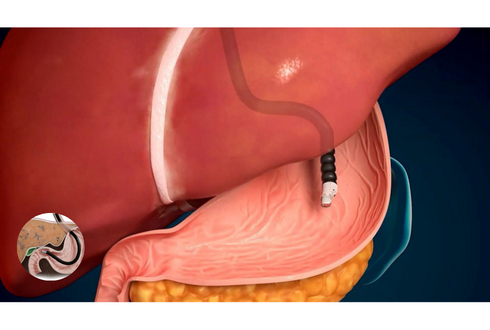 Advancement in Endoscopic Ultrasound