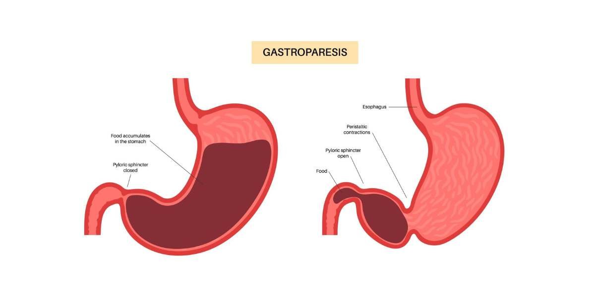 gastroparesis