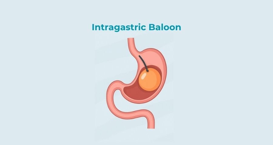 Intragastric Baloon placement in Gurgaon