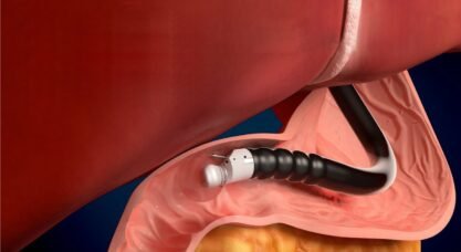 Endoscopic Ultrasound Gurgaon