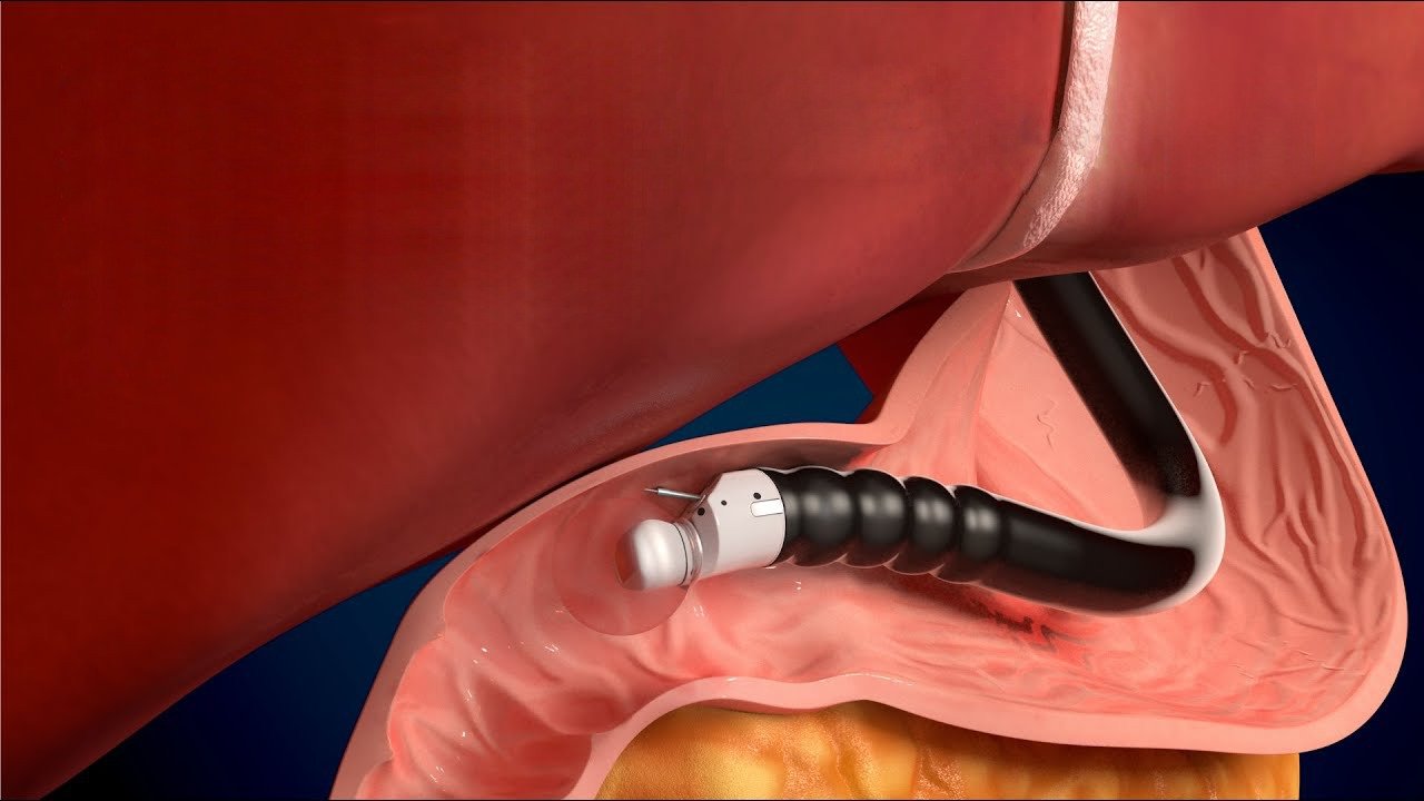 Endoscopic Ultrasound Gurgaon