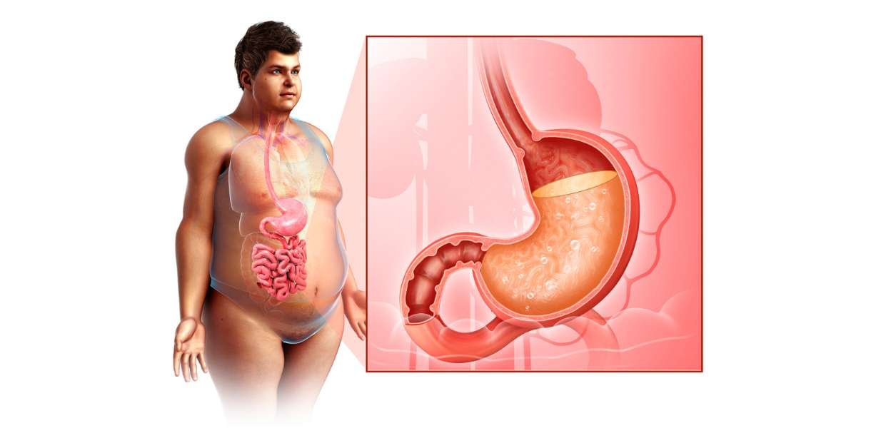 acidity treatment in Gurgaon