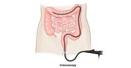 when a colonoscopy needed