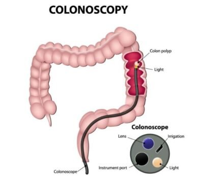 colonoscopy in gurgaon