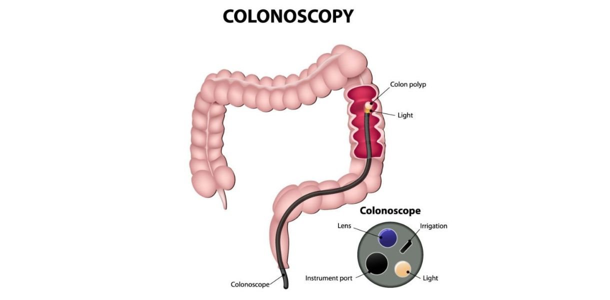 colonoscopy in gurgaon