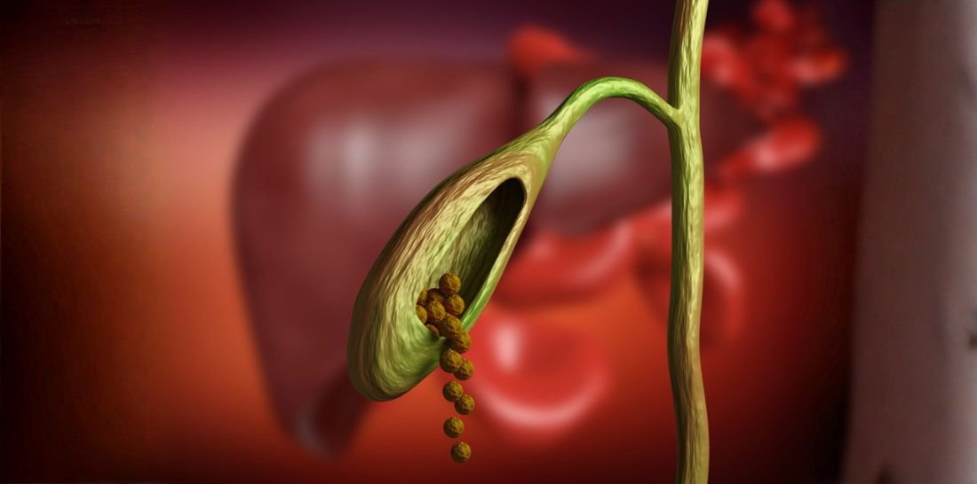 gallbladder stone removal surgery Gurgaon