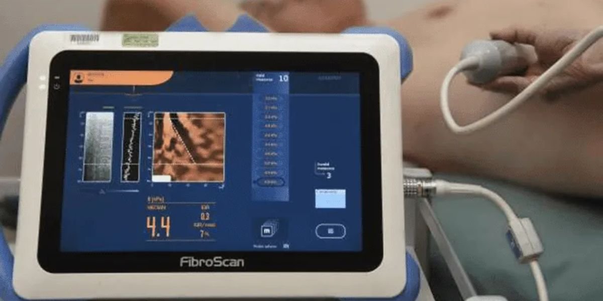 fibroscan