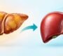 Fatty liver treatment 90x80